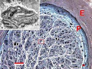 Demyelinized nerve with bands of Büngner (square, inset) . P- perineurium, | E - epineurium. (Human, sural nerve.) Scale 0.2 mm.